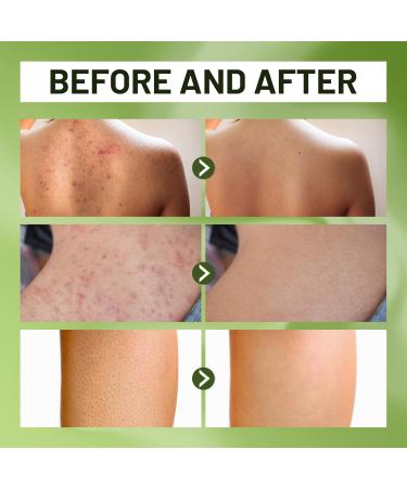 ABERA Bitter Melon Shower Gel | Gentle Body Wash for Soothing and Cleansing High-Performance BHA Folliculitis Body Wash Reduces Back Acne Keratosis Pilaris & Folliculitis Treatment 10 14 fl oz - Buy Online on GoSupps.com