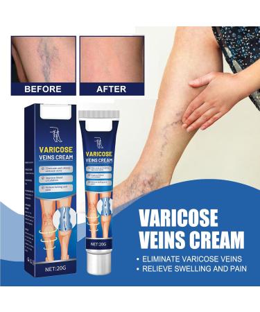 Vein Relief Cream 20g - Natural Varicose Vein Gel for Pain Relief - Buy Online on GoSupps.com