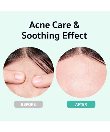 BRING GREEN X NETFLIX SQUID GAME Edition Zinc Teca Serum 25mL | Calming Serum for Skin Soothing & Oil Control | Includes Free Gonggi Tossing Game as Seen in Squid Game - Buy Online on GoSupps.com