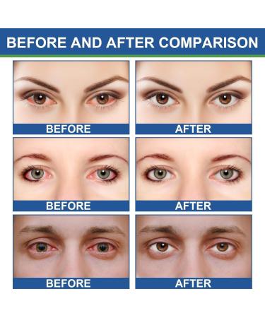 IFFANY Eye Relief Ointment Lubricating Eye Ointment Soothing Eye Ointment Eye Ointment for Dry Eyes at Night Quickly Relieve Eye Fatigue - Buy Online on GoSupps.com