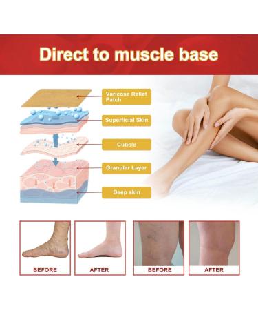 Buy Varicose Vein Plaster | 10 & 12 Piece Venous Stickers for Spider Vein Care | Reduce Appearance of Veins - Buy Online on GoSupps.com