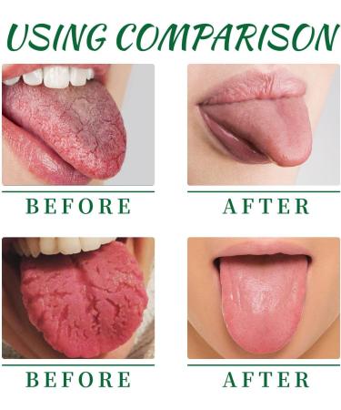 3PCS Tongue Relief Treatment Spray Reduce Swelling Tongue Relief Treatment Spray for Bad Breath - Buy Online on GoSupps.com
