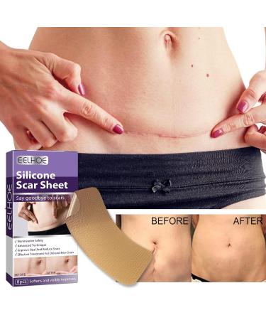Silicone Fade Stretch Marks and Scars Improving Facial Skin - One Size - Buy Online on GoSupps.com