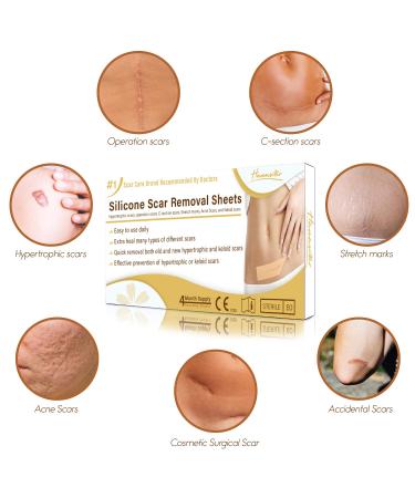 HANASCAR Professional Silicone Scar Removal Sheets - Treat C-Section, Burn, Acne & Stretch Mark Scars - Works on Old & New Scars - 5.7 x 1.57 - Buy Online on GoSupps.com