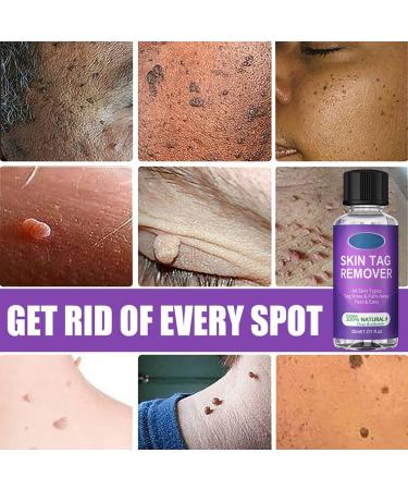 LDREAMAM Skin Tag Removal Gel - Safe & Effective Mole & Wart Remover - Buy Online on GoSupps.com