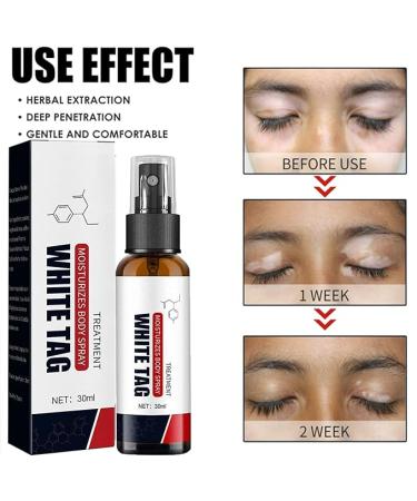 3Pcs Dermax Psoriasis Treatment Spray- Soothing Coal Tar Cream for Moisturizing Relief - Buy Online on GoSupps.com