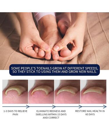 Ingrown Toenail Treatment Oil - 2PCS | Anti-Paronychia Relief & Ingrown Toenail Correction Drops - Buy Online on GoSupps.com