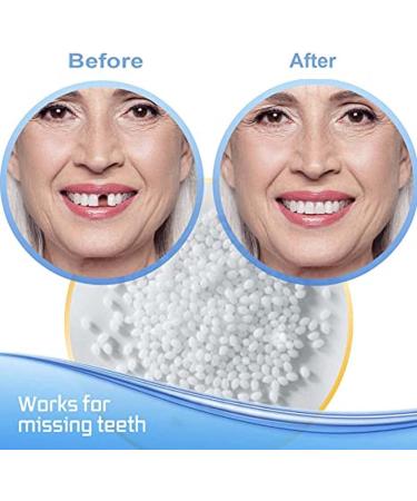 TEYSHA Temporary Tooth Repair Beads Kit - DIY Heat Fit Beads (50g) - Buy Online on GoSupps.com