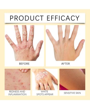 Vitiligo Bee Venom Treatment Cream | Effective Bee Venom Therapy for Skin Rejuvenation - Buy Online on GoSupps.com