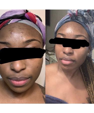 Dark Spot Corrector & Brightening Serum with Kojic Acid, Vitamin C, Salicylic Acid & More | Melasma Treatment Cream by Admire My Skin - Buy Online on GoSupps.com