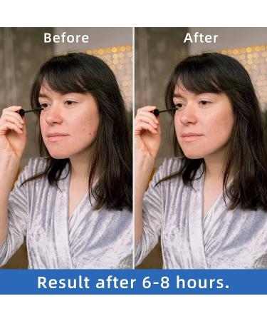 ovand Acne Pimple Patches - Ultra-Thin Hydrocolloid Spot Stickers for Face - 72 Acne Dots - Extra Adhesion Zit Patch - Optimal Healing Treatment - Buy Online on GoSupps.com