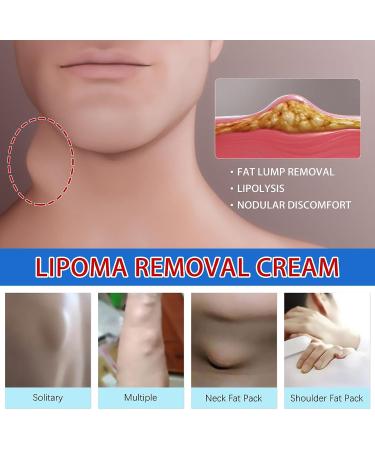 Lipoma Removal Cream 20g - Natural Treatment for Lipoma Care & Discomfort - Buy Online on GoSupps.com