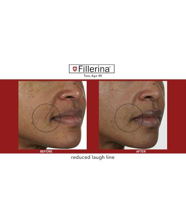 Fillerina 12 Densifying-Filler - Intensive Filler Treatment Grade 3 (2x30ml) - Buy Online on GoSupps.com