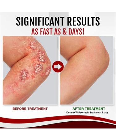 Dermax Psoriasis Treatment Spray Psoriasis Treatment Spray Kolmax Psoriasis Relief Spray Scalp Psoriasis Treatment Spray 30ml Psoriasis Treatment Spray (3 PCS) - Buy Online on GoSupps.com