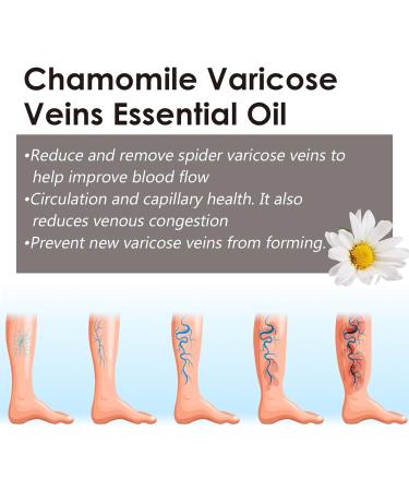 Marronie Oil for Varicose Veins Marronie Chamomile Essential Oil for Varicose Veins 1/3/5 Pack Marronie Oil Varicose Veins (3pcs) - Buy Online on GoSupps.com
