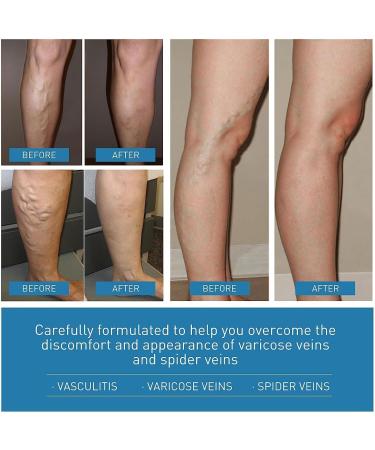 Raura Varicose Veins Treatment Cream Raura Varicose Veins Cream Varicose Veins Treatment for Legs (1) - Buy Online on GoSupps.com
