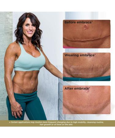 Embrace Scar Treatment - Extra Large Silicone Sheets (6.3in) for New Scars | 60 Day Supply - Buy Online on GoSupps.com