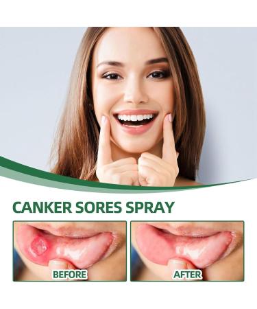 Mouth Ulcer Treatment Spray Mouth Ulcer Spray Mouth Ulcer Treatment for Adults Canker Sore Treatment Herbal Mouth Spray Breath Spray for Bad Breath Canker Relief Spray Mouth Freshener Spray 20ml - Buy Online on GoSupps.com