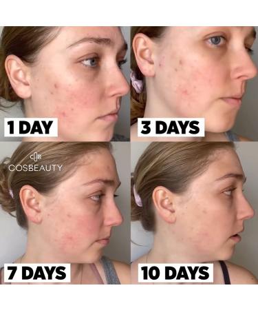 COSBEAUTY Plasma Acne & Blackhead Removal Facial Machine - White - Buy Online on GoSupps.com