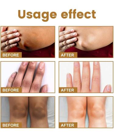 DUBUSH Black Acanthopanax Drops Powerful Whitening Essence Dark Spot Remover Lightens Body Dark Skin Permanent Whitening - Buy Online on GoSupps.com