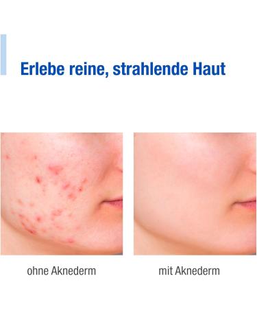 Aknederm Ointment 60g - Targeted Care for Skin Imperfections | Skin-Tinted Perfume-Free & Vegan - Buy Online on GoSupps.com