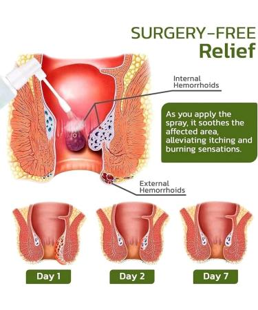 Hemorrhoids Relief Spray 30ml | Natural Treatment for Piles & Anal Fissures - Buy Online on GoSupps.com