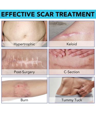 Silicone Scar Sheets 20Pcs - Professional Reusable Silicone Scar Tape for Surgical Scars, C-Section, Burn, Keloid & Acne Removal - Buy Online on GoSupps.com