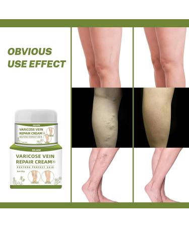 Varices Cr me Cr me de Traitement Des Veines D'araign e pour Les Jambes Cr me pour Les Jambes Soulage Rapidement Les Jambes Fatigu es Et Lourdes - Buy Online on GoSupps.com