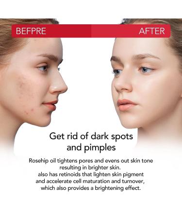 Organic Rosehip Seed Oil - Cold Pressed, Unrefined Anti-Aging Solution for Face, Hair, Nails - 2.02 Fl Oz (Pack of 1) - Buy Online on GoSupps.com