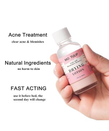 Acne Drying Lotion | Overnight Acne Treatment for Pimples & Blemishes | Fast Spot Treatment (1OZ) - International Shipping - Buy Online on GoSupps.com