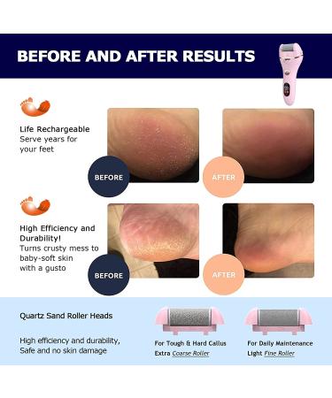 Electric Foot File Callus Remover | IPX7 Waterproof Portable Electronic Foot Scrubber | Pedicure Tool for Removing Dead, Hard, Cracked Dry Skin | Powerful Pedi Spa (Pink) - Buy Online on GoSupps.com