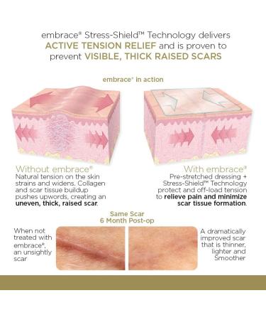 Embrace Scar Treatment - Extra Large Silicone Sheets (6.3in) for New Scars | 60 Day Supply - Buy Online on GoSupps.com