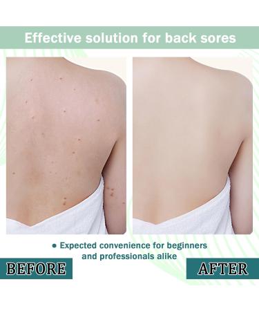 Back Acne Treatment Spray - Moisturizing Body Cleanser for Men & Women | Shop Now for Clear Skin - Buy Online on GoSupps.com