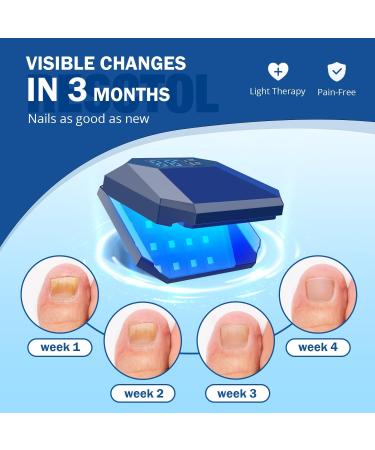 Nail Fungus Cleaning Device for Multiple fingers 905nm Infrared Light + 470nm Blue Light Highly Effective Treatment for Home Use Treat and effectively prevent (Navy) - Buy Online on GoSupps.com