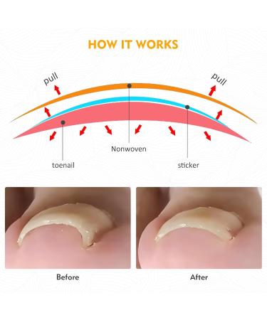 Xinzan 2 Types Ingrown Toenail Treatment Patch with Ingrown Toenail Tool Professional Ingrown Toenail Corrector Tools for Toenail Care Protect Toe Nail - Buy Online on GoSupps.com