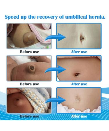 Buy S Baby Belly Band Umbilical Hernia Belt | Adjustable Navel Truss Wrap for Newborns/Infants - Soft & Skin-Friendly - Blue/White - Buy Online on GoSupps.com