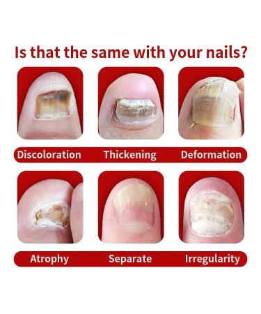 Onychomycosis Relief Oil - Rapid Toenail Repair & Ingrown Toenail Treatment (5 Sticks) - Improve Nail Health - Buy Online on GoSupps.com