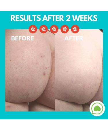 Acne Clearing Lotion for Butt, Back, Bum & Thigh - Special Treatment Formula for Pimples, Ingrown Hairs, Razor Burn, Blackheads & Blemishes - Vegan & Cruelty Free - Buy Online on GoSupps.com