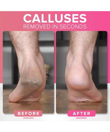 RUSTPROOF Callus Remover for Feet | XL Professional Pedicure Foot File & Spa Products | Effective Wet & Dry Dead Skin Scrubber - Non-Electric Foot Care Kit - Buy Online on GoSupps.com
