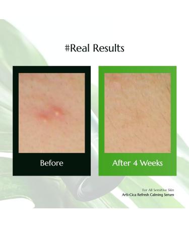 molvany Arti-cica Refresh Calming Serum - ASAP Soothe&Calm Skin, Improve Skin Balance Recommended for Sensitive Skin, 1.01 fl. oz. - Buy Online on GoSupps.com