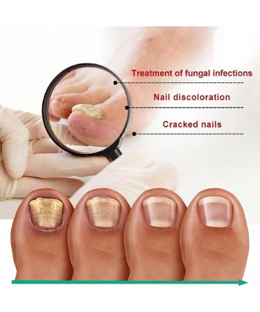 Quick Relief Oil Fungal Nail Treatment Rapid Relief Oil Nail Fungus Treatment For Toenail Nail Treatment Oil Toe Nail Fungal Treatment Onychomycosis Nail Treatment Toenail Repair for Damaged Nails - Buy Online on GoSupps.com