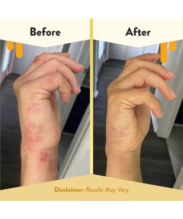 ECZEMA HONEY Antioxidant Body Oil - Unscented Moisturizing Spray for Eczema-Prone Skin - Perfect for Women Men & Kids - 8 Fl Oz - Buy Online on GoSupps.com