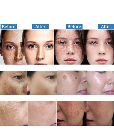 Dark Spot Remover Serum for Face with Vitamin C, Retinol, Salicylic Acid & More - Hyperpigmentation & Acne Scar Treatment - Buy Online on GoSupps.com
