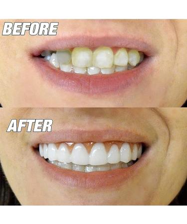 Adjustable Snap-On Dentures for Men - Eat, Smile & Cover Imperfections Instantly - Top & Bottom Set of Temporary Fake Teeth for Confidence Boost - Buy Online on GoSupps.com