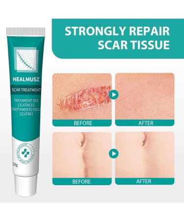TULAMORIY 20 g scar cream soothes scar ointment highquality scar ointment cream for the care of scars gentle scar cream improves the appearance of the skin cares for fresh and old - Buy Online on GoSupps.com