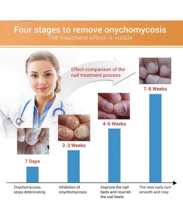 Fungal Nail Treatment Essence - Extra Strong Nail Repair Solution for Fingernails & Toenails - Buy Online on GoSupps.com