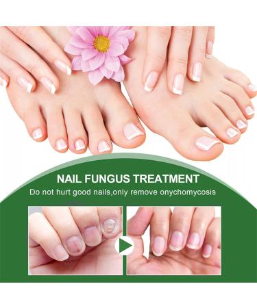 Fungal Nail Treatment - Extra Strong Nail Fungus Treatment for Toenail and Fingernail - Anti fungus Nail Repair and Strengthen Fix & Renew Damaged Broken Nails Restoring Healthy Nails-30ml - Buy Online on GoSupps.com