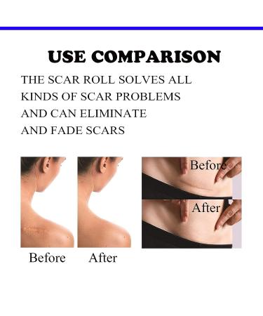 Silicone Scar Tape Roll - Easy-Tear Gel Tape for Surgery Scars - 1.6 x 120 Inch - Medical Grade Silicone Sheets - Wound Dressing for Scar Management - Buy Online on GoSupps.com