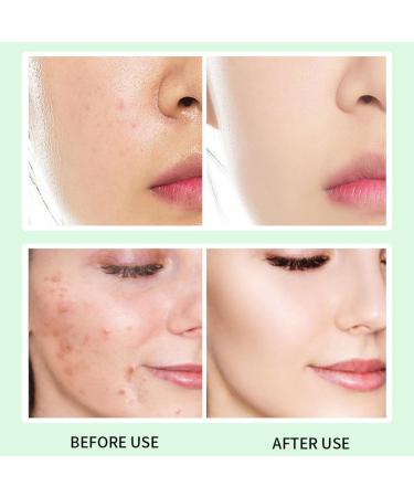Azelaic Acid Cream Azelaic Acid Serum Cream 14% Azelaic Acid Serum Face Cream with Niacinamide & Vitamin C Anti Redness Cream Reduce Blemishes Remove Acne&Rosacea Shrink Pore for All Skin Types - Buy Online on GoSupps.com