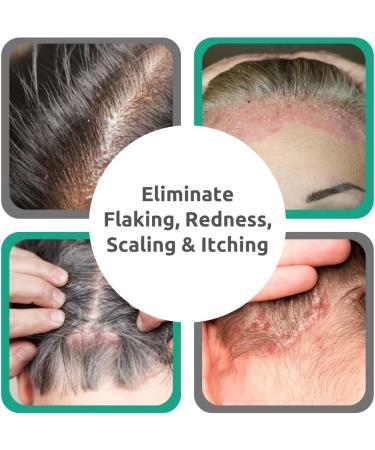 Dr. Blaine's Scalp Psoriasis Serum for Itchy Flaky Scalp | Salicylic Acid & Allantoin Treatment Fragrance-Free Paraben-Free | Sensitive Scalp Psoriasis Relief Travel Size 2 oz - Buy Online on GoSupps.com